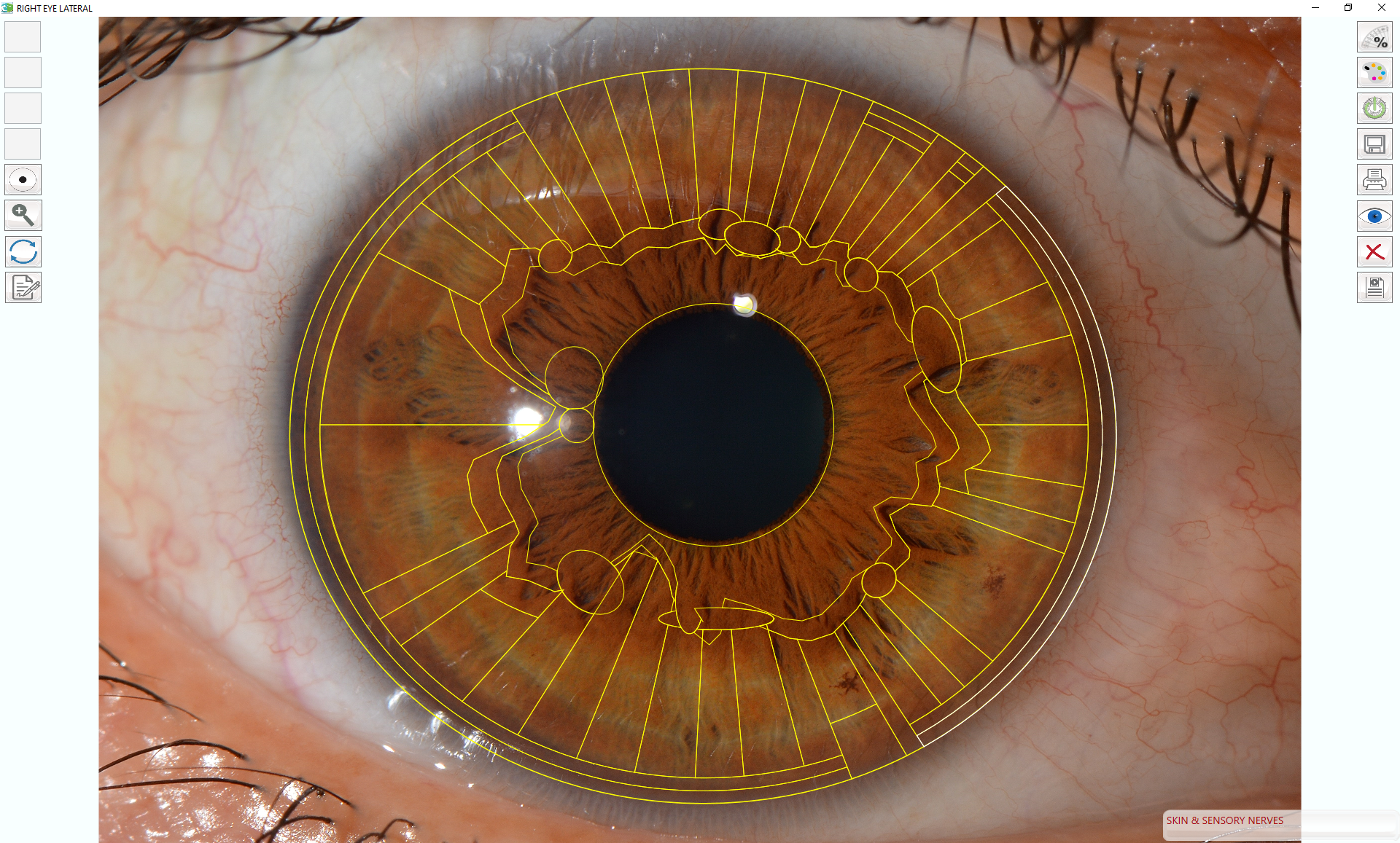 Hematogenic iris with chart overlay using Dr. Pesek's Iris Software