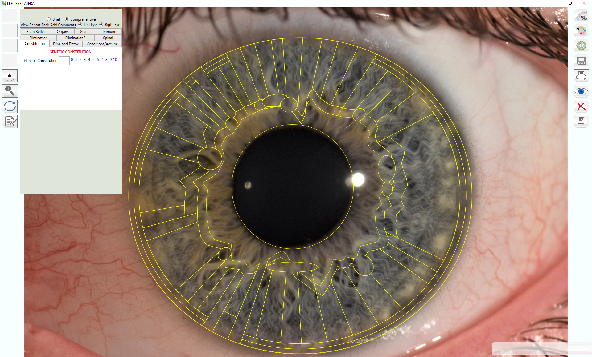 Lymphatic iris with chart overlay using Dr. Pesek's Iris Software 2