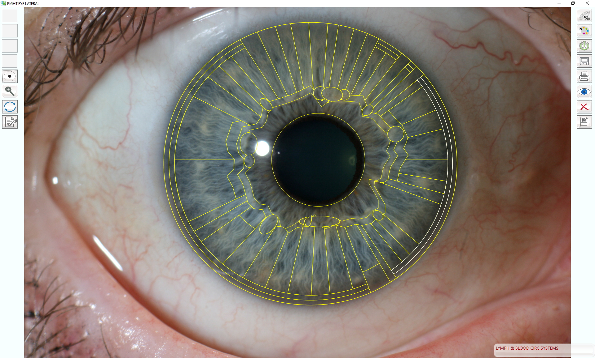 Lymphatic iris with chart overlay using Dr. Pesek's Iris Software