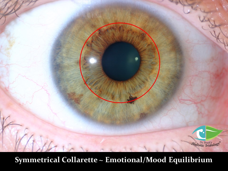 Iris Photos With Interpretation « Dr. Pesek's Holistic Iridology