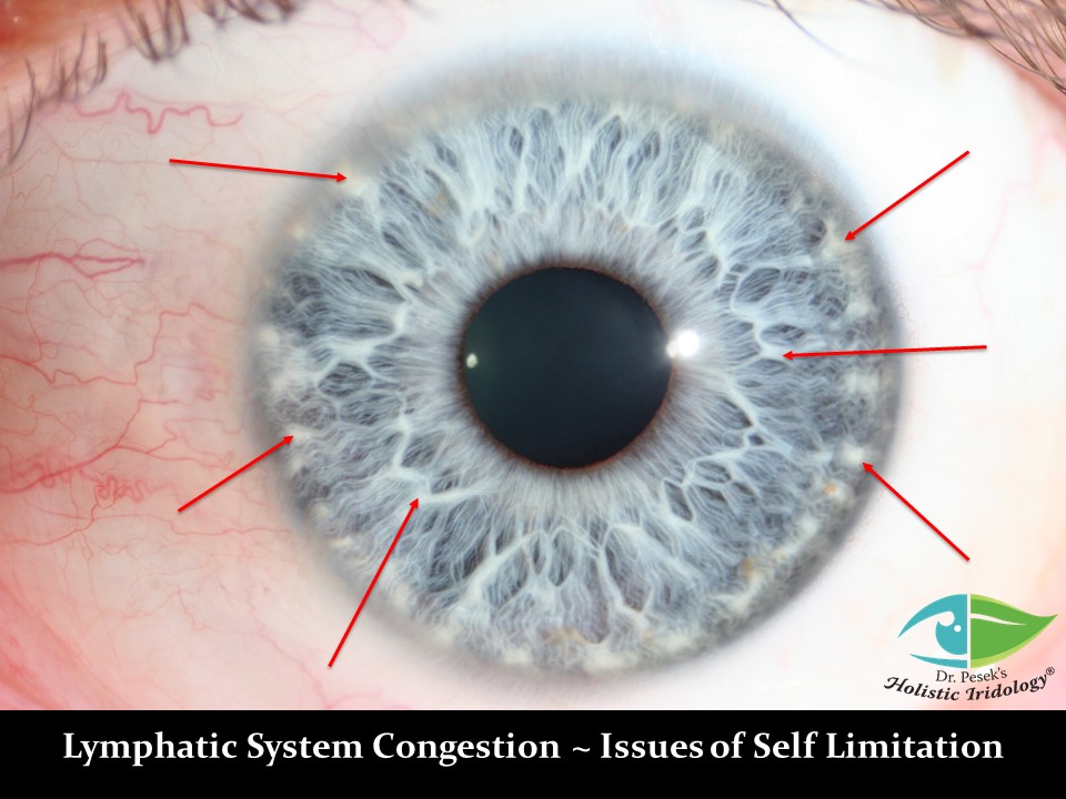 Iris Photos with Interpretation – Dr. Pesek's Holistic Iridology